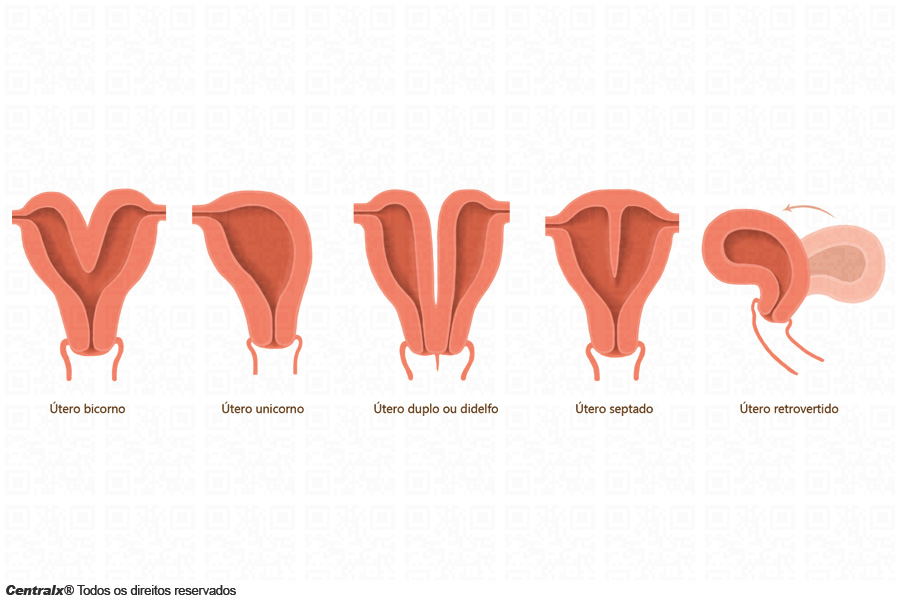 Malformações uterinas: como ocorrem?